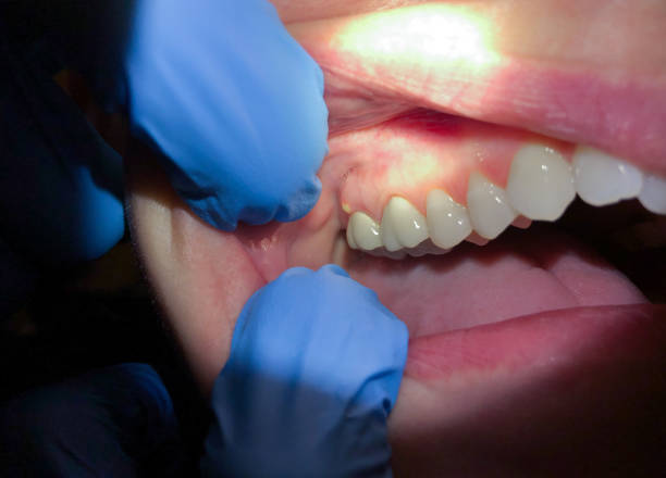 Best Emergency Root Canal Treatment in Wilson, OK
